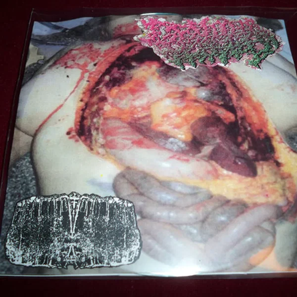 Genital Herpes / Butyric Fermentation Abuse