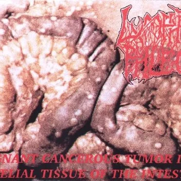 Malignant Cancerous Tumor in the Epitelial Tissue of the Intestine