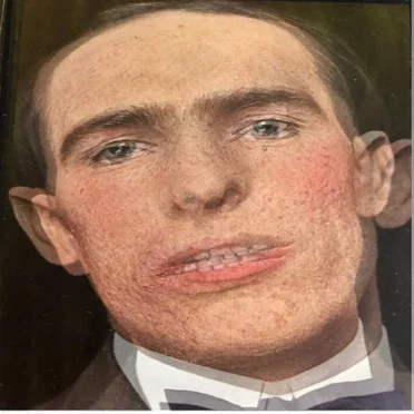 Burns