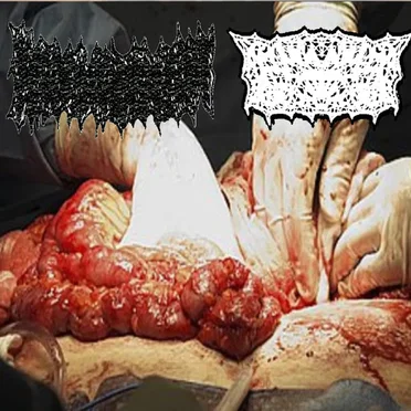 Bowel Fermentation / Acute Tracheal Stenosis