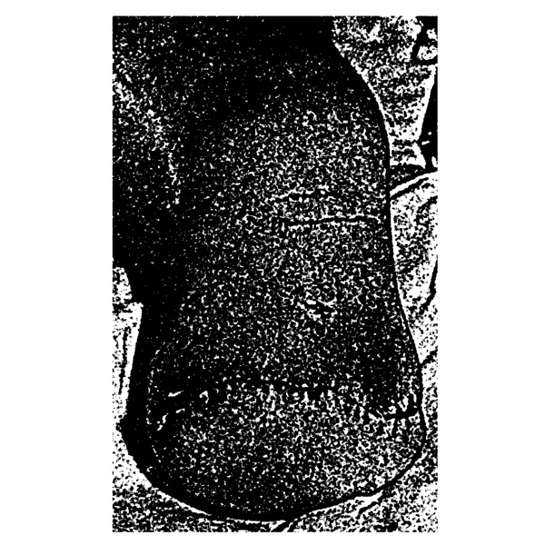 Traumatic Amputations III