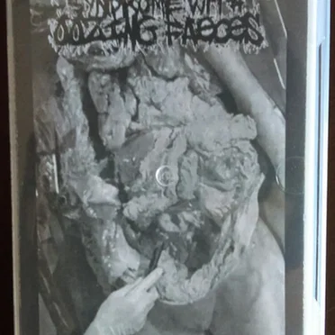 Acute Colonic Pseudo-Obstruction / Gastrienterological Perversion