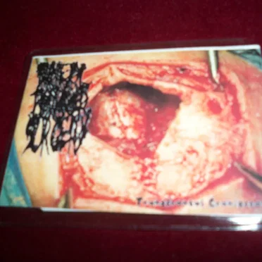 Transfrontal Craniectomy