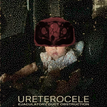 Ejaculatory Duct Obstruction (single mix)