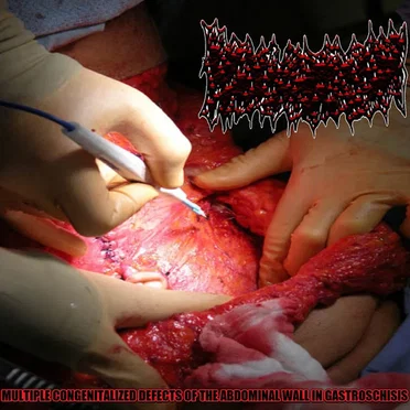 Multiple Congenitalized Defects Of The Abdominal Wall In Gastroschisis