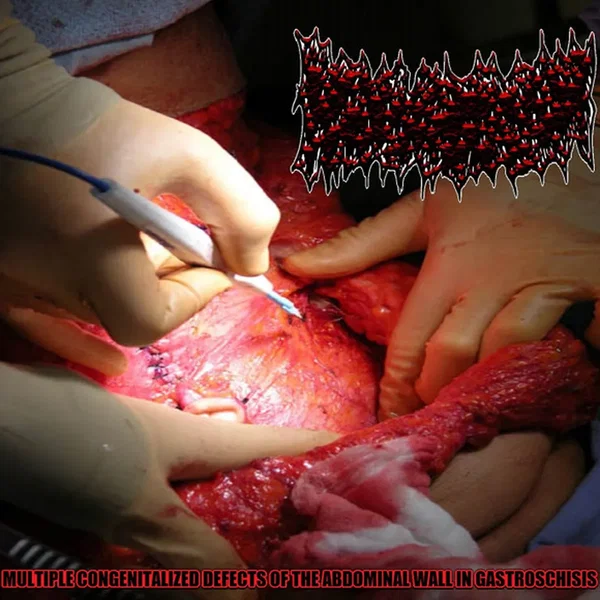 Multiple Congenitalized Defects Of The Abdominal Wall In Gastroschisis