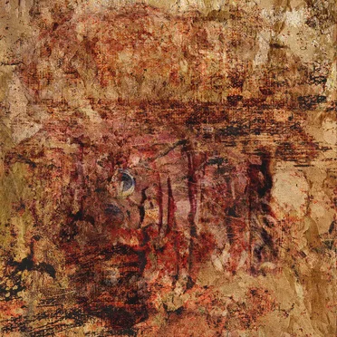 bilateral anophthalmia (tower spring) by megalencephalic leukoencephalopathy with subcortical cysts - album cover