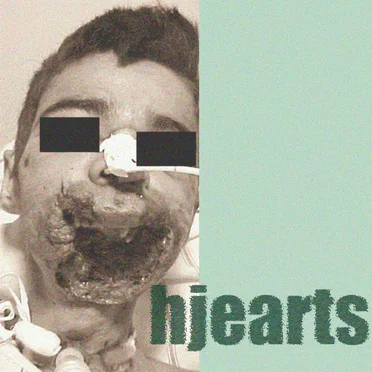 Myiasis