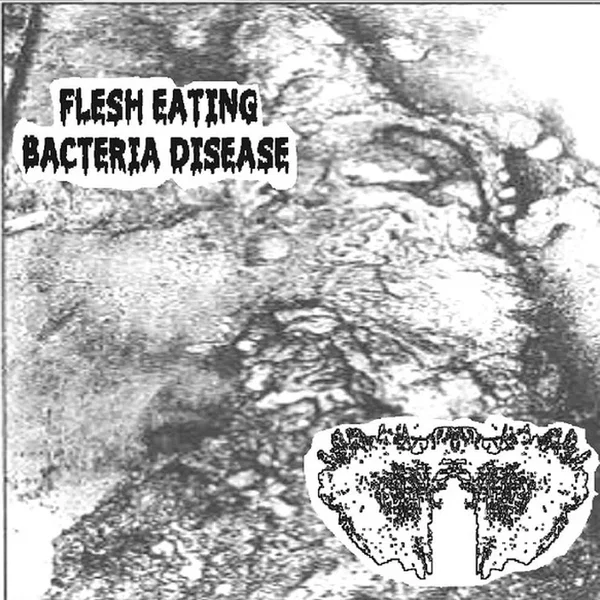 Flesh Eating Bacteria Disease / Carcinomas Of Unknown Primary Origin