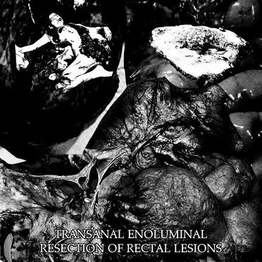 Transanal Enoluminal Resection of Rectal Lesions