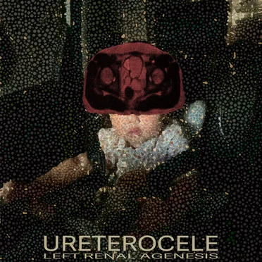 Ureterocele