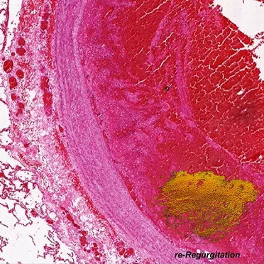 Re-Regurgitation by Anthropophagical Fungus - album cover
