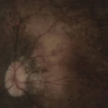 Bereft of Xerotic Layers