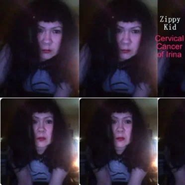 Cervical Cancer of Irina