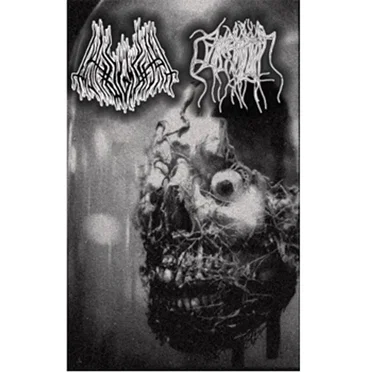 Pathogenesis / Parasitic Twin