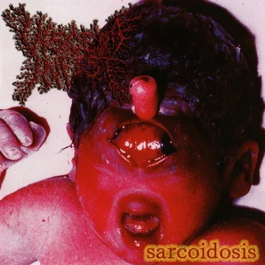 Sarcoidosis