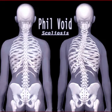 Scoliosis