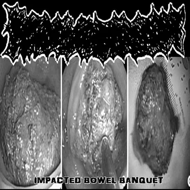 Impacted Bowel Banquet