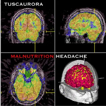 Malnutrition Headache by Tuscaurora - album cover