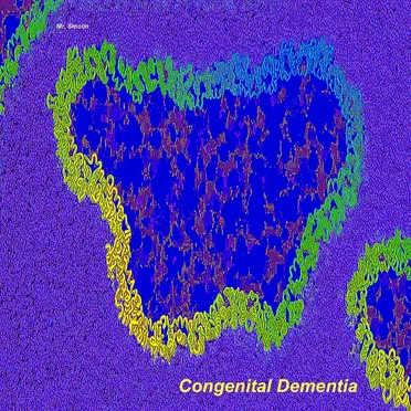 Congenital Dementia