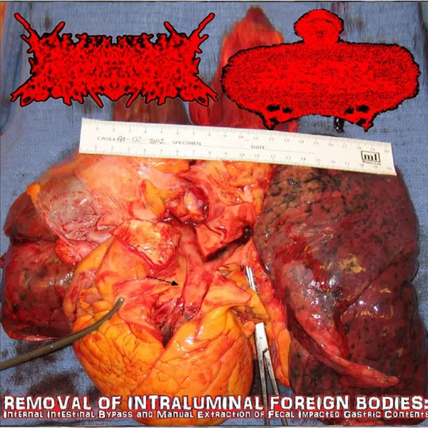 Removal Of Intraluminal Foreign Bodies: Internal Intestinal Bypass And Manual Extraction Of Fecal Impacted Gastric Contents