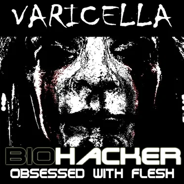 Varicella
