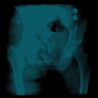 Cracked Pelvis