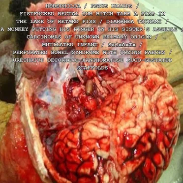 Hebephilia / Fetus Kalops / FxRxCxBxTxAxPxIxTxLxOxRxPx / Diarrhea Tsunami / AxMxPxHxFxIxHxSxAx / Carcinomas Of Unknown Primary Origin / Mutilated Infant / SxCxAxTx / Perforated Bowel Syndrome With Oozing Faeces / UxDxXxMxGxSx