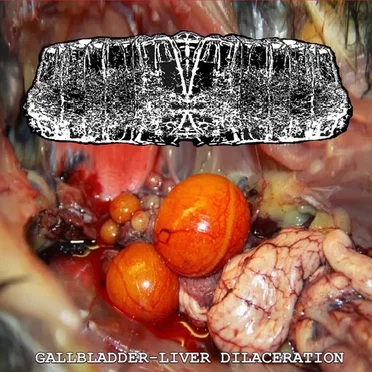 Gallbladder-liver Dilaceration
