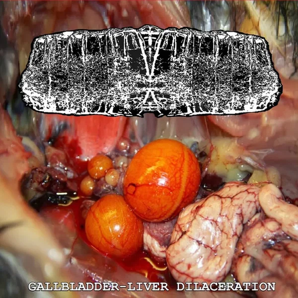 Gallbladder-liver Dilaceration