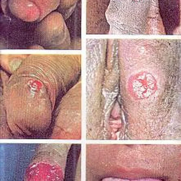 Tumours
