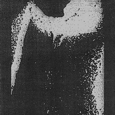 Bilirubin