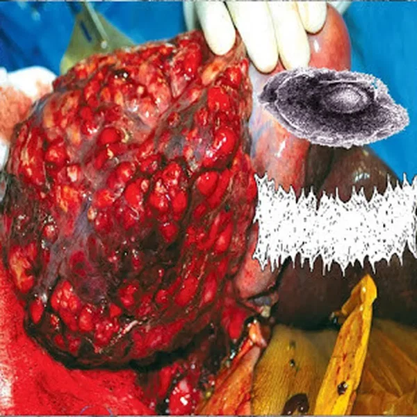 Paraganglioma / Bowel Fermentation