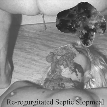 Re-regurgitated Septic Slopmeal