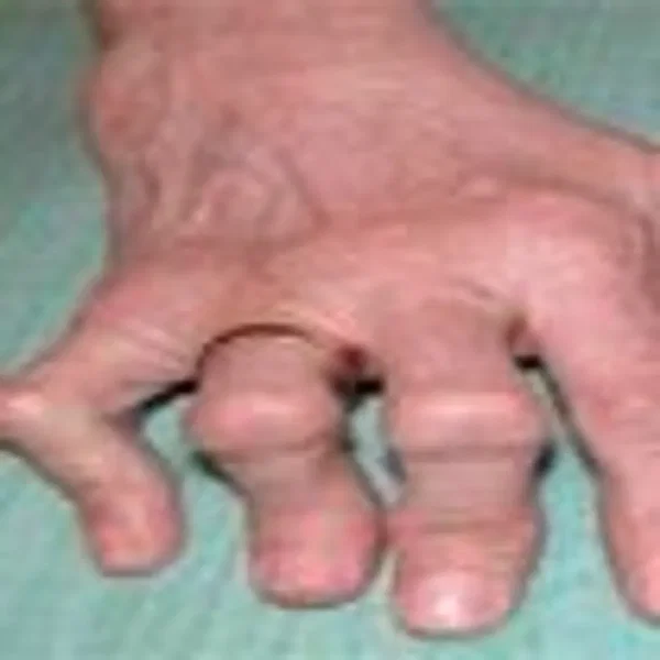 loh