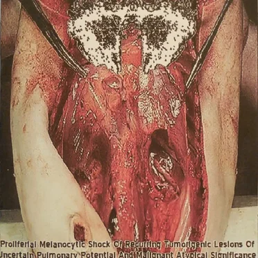 Proliferal Melanocytic Shock Of Recurring Tumorigenic Lesions Of Uncertain Pulmonary Potential And Malignant Atypical Significance