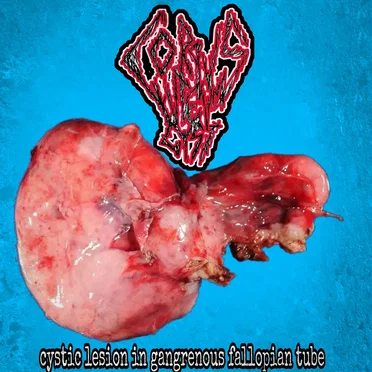 Cystic Lesion in Gangrenous Fallopian Tube