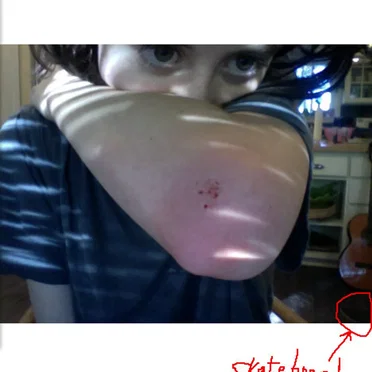 skinned elbow = now you're cool