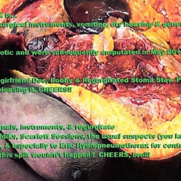Hydropneumothorax / 3XA